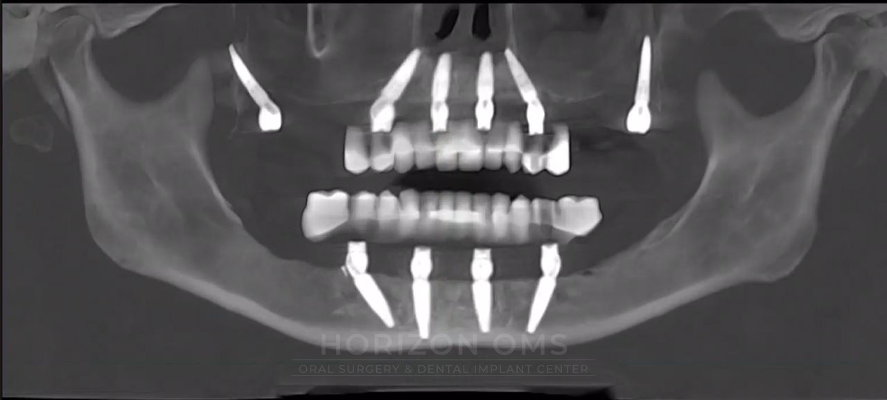 CBCT panoramic X-ray showing bilateral pterygoid implants supporting full-arch restoration in both jaws — case treated by Dr. Ali Al-Qudsi at Horizon OMS of Chicago