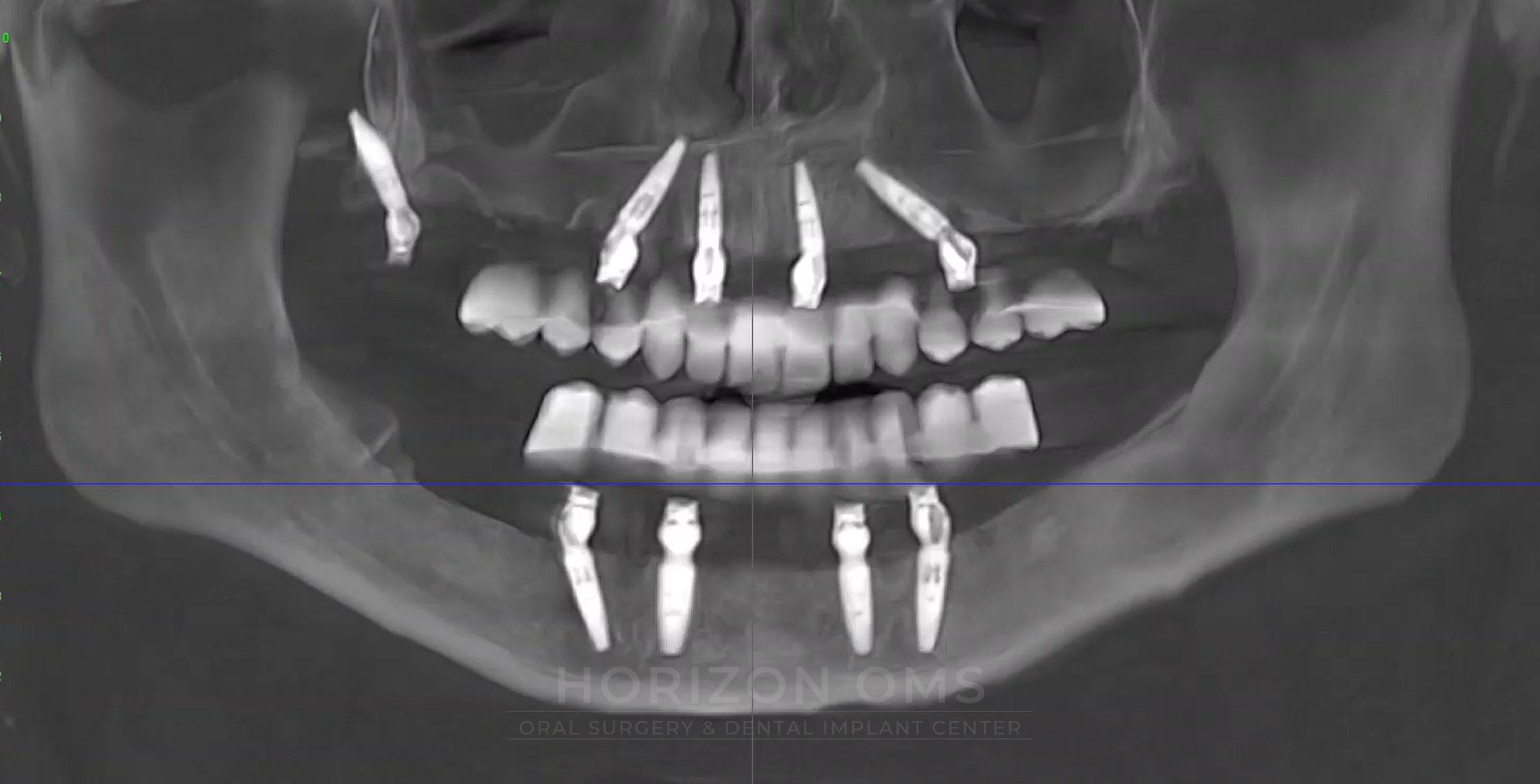 CBCT panoramic X-ray showing full-arch implant reconstruction of both upper and lower jaws — case treated by Dr. Ali Al-Qudsi at Horizon OMS of Chicago