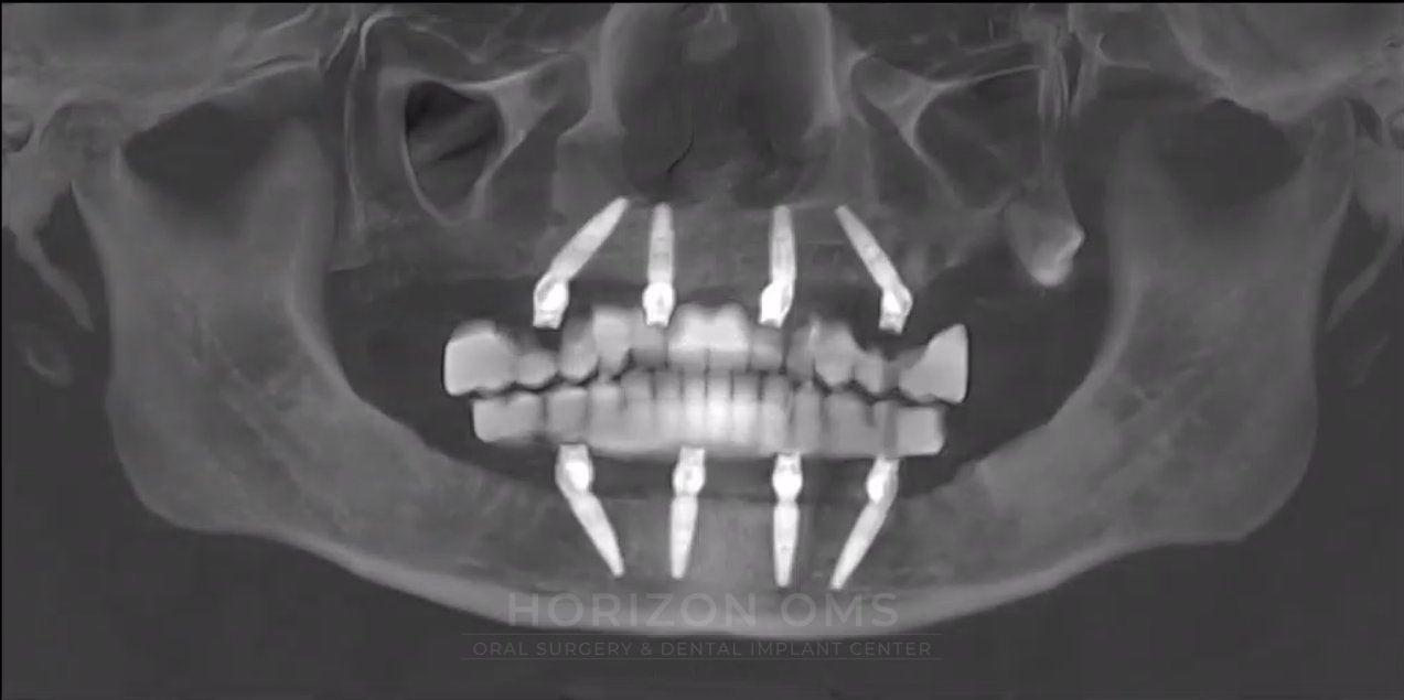 CBCT panoramic X-ray showing full-arch implant-supported replacement of all missing and severely worn teeth with same-day fixed prosthesis — case treated by Dr. Ali Al-Qudsi at Horizon OMS of Chicago