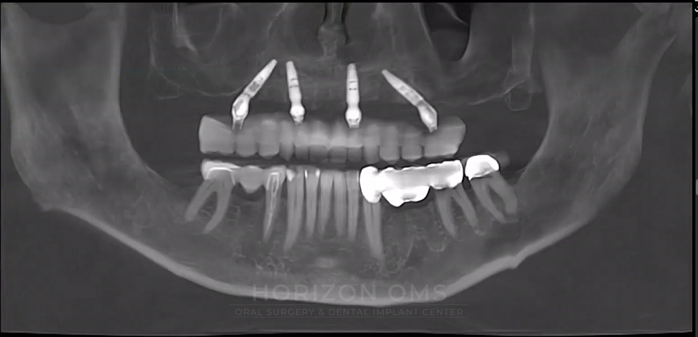 CBCT panoramic X-ray showing full-arch implant-supported prosthesis replacing failing upper dentition — case treated by Dr. Ali Al-Qudsi at Horizon OMS of Chicago