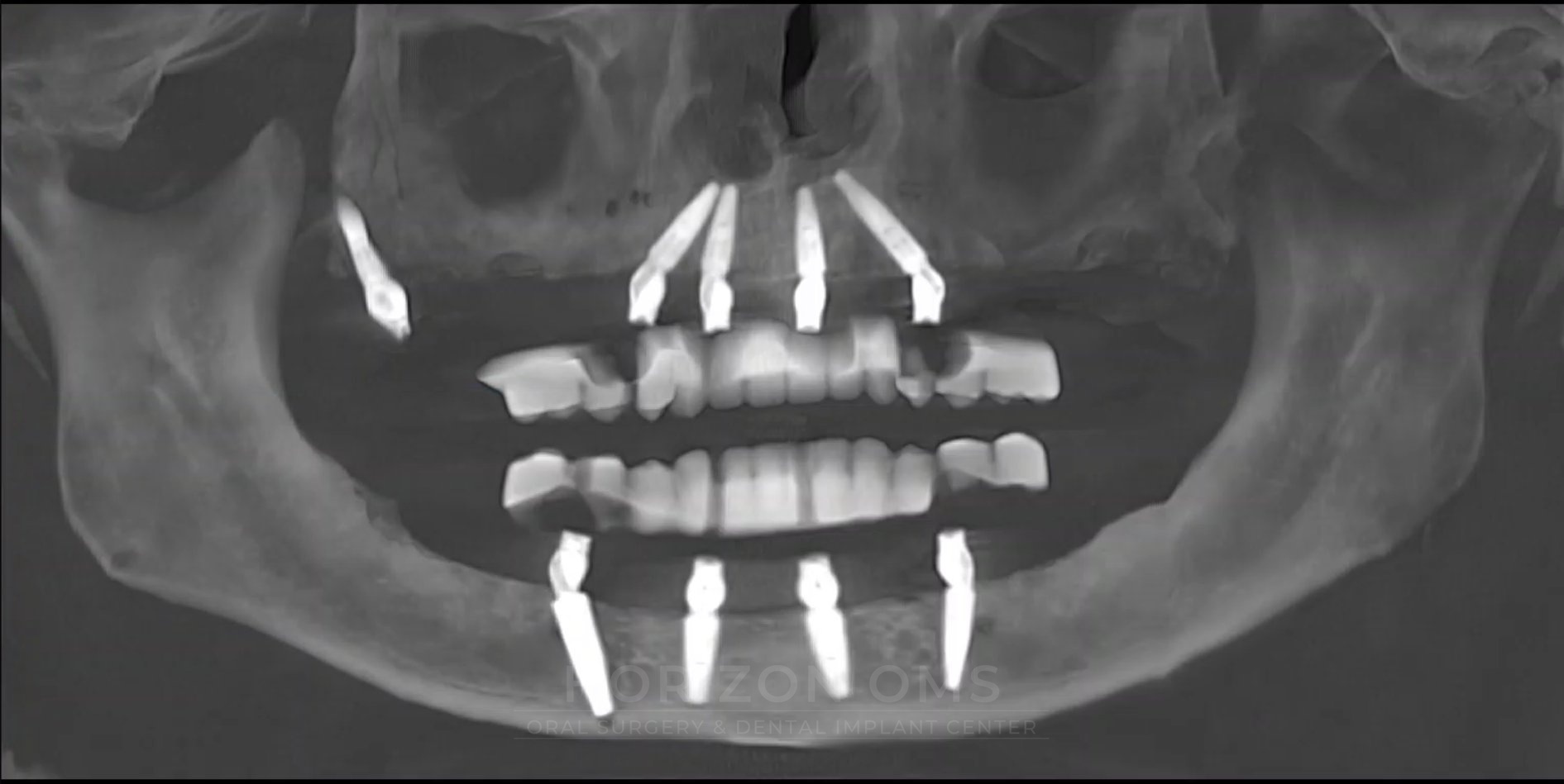 CBCT panoramic X-ray showing upper arch full-arch implant restoration using pterygoid implants — case treated by Dr. Ali Al-Qudsi at Horizon OMS of Chicago