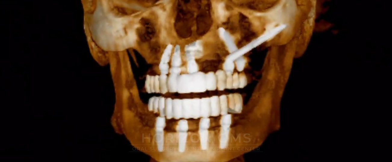 3D CBCT rendering showing a single zygomatic implant anchored in the cheekbone to bypass an impacted tooth in the palate — case treated by Dr. Ali Al-Qudsi at Horizon OMS of Chicago