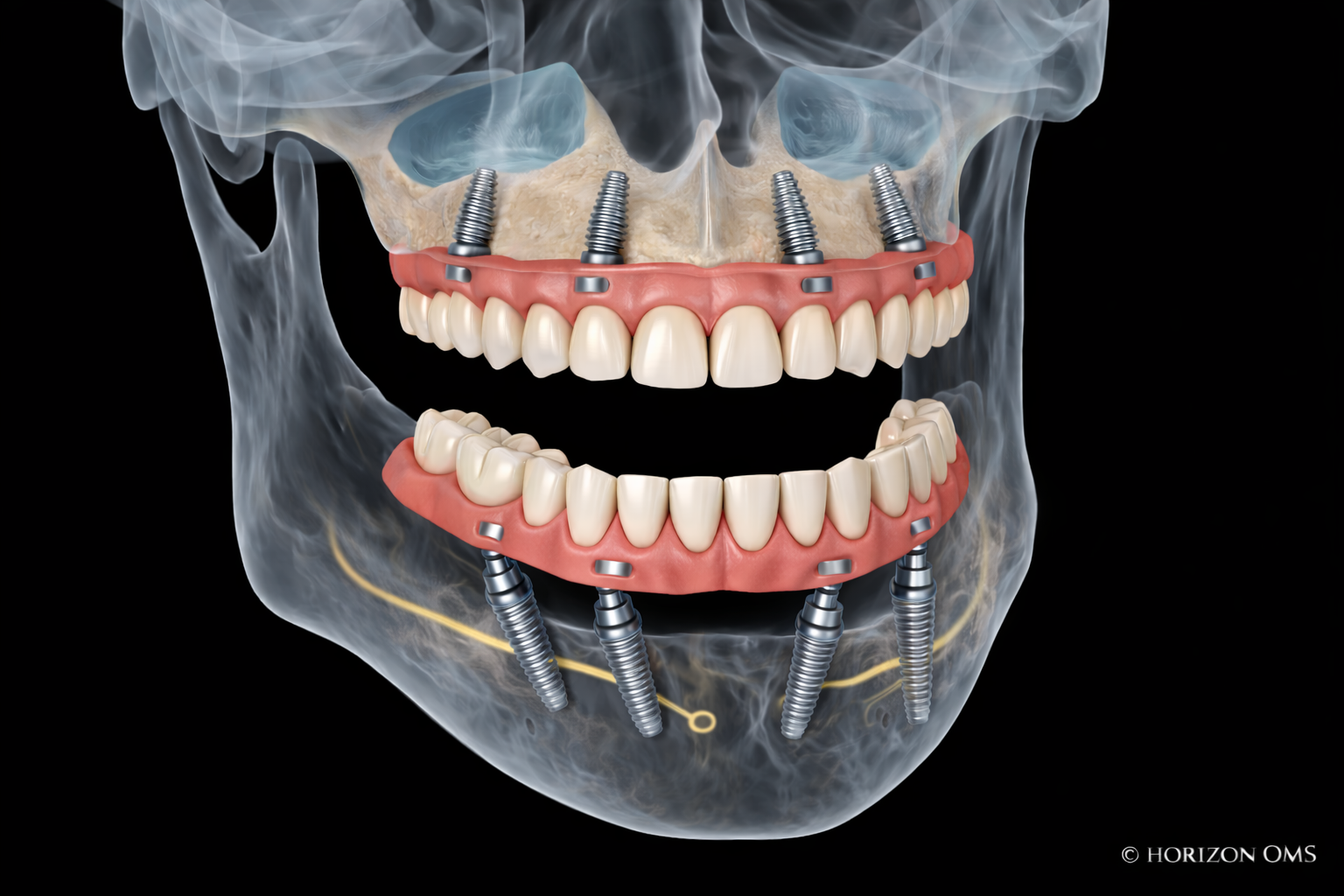 All-on-X full arch dental implant surgery restoration in Lombard Illinois