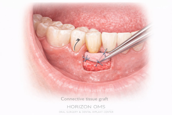 Soft tissue grafting procedure for gum health and implant support