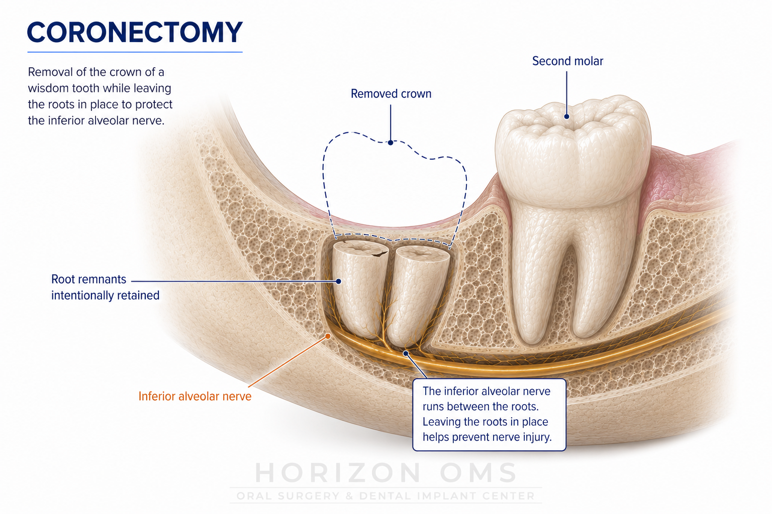 Coronectomy illustration showing retained wisdom tooth roots near the inferior alveolar nerve