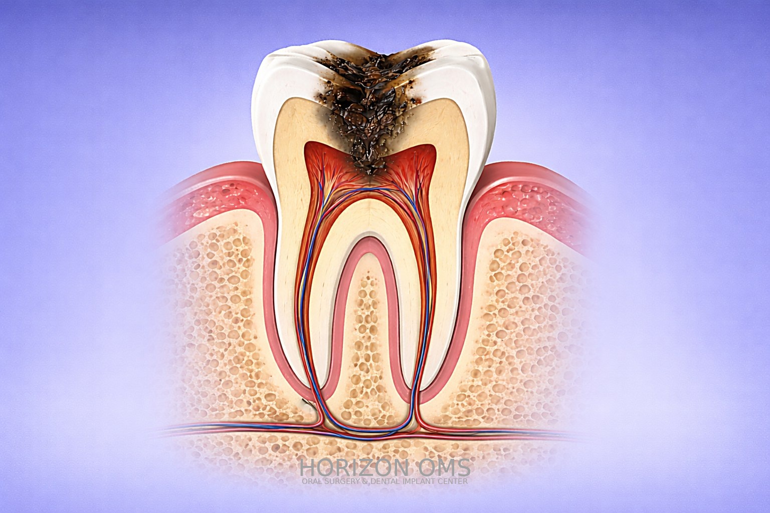 Non-wisdom tooth extraction procedure by experienced oral surgeon Western suburbs
