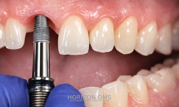 Dental implant surgery placement Lombard Illinois oral surgeon