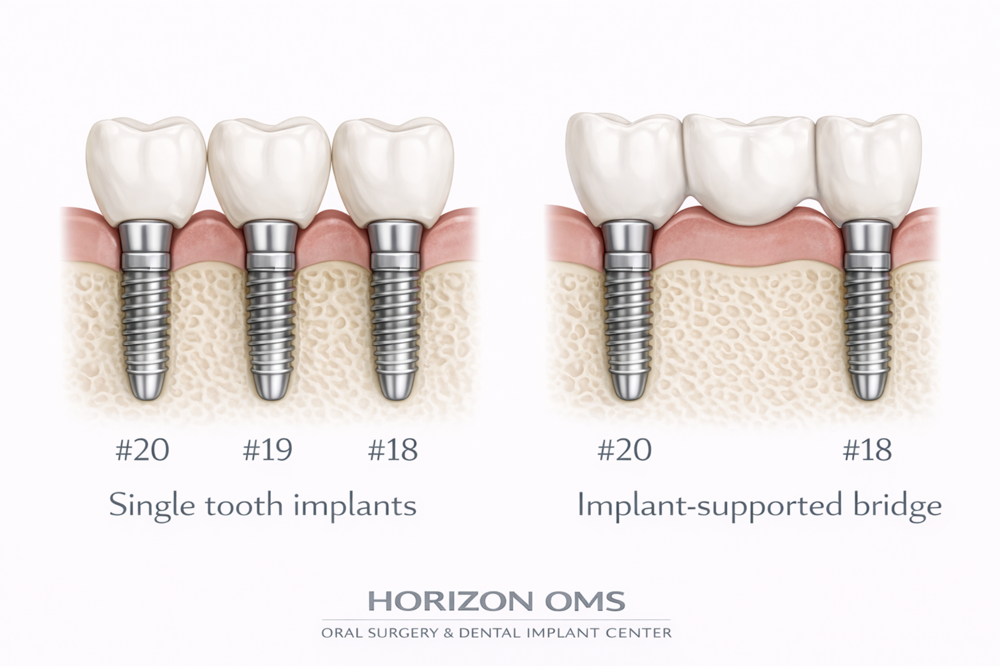 Dental implant restorative planning showing single tooth implants (#20, #19, #18) versus an implant-supported bridge supported by implants at #20 and #18