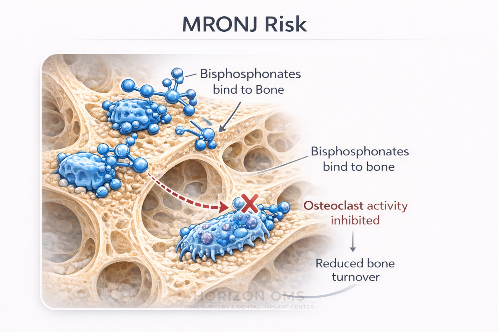 MRONJ risk and tooth extraction planning for patients taking Prolia or bisphosphonates — Horizon OMS of Chicago