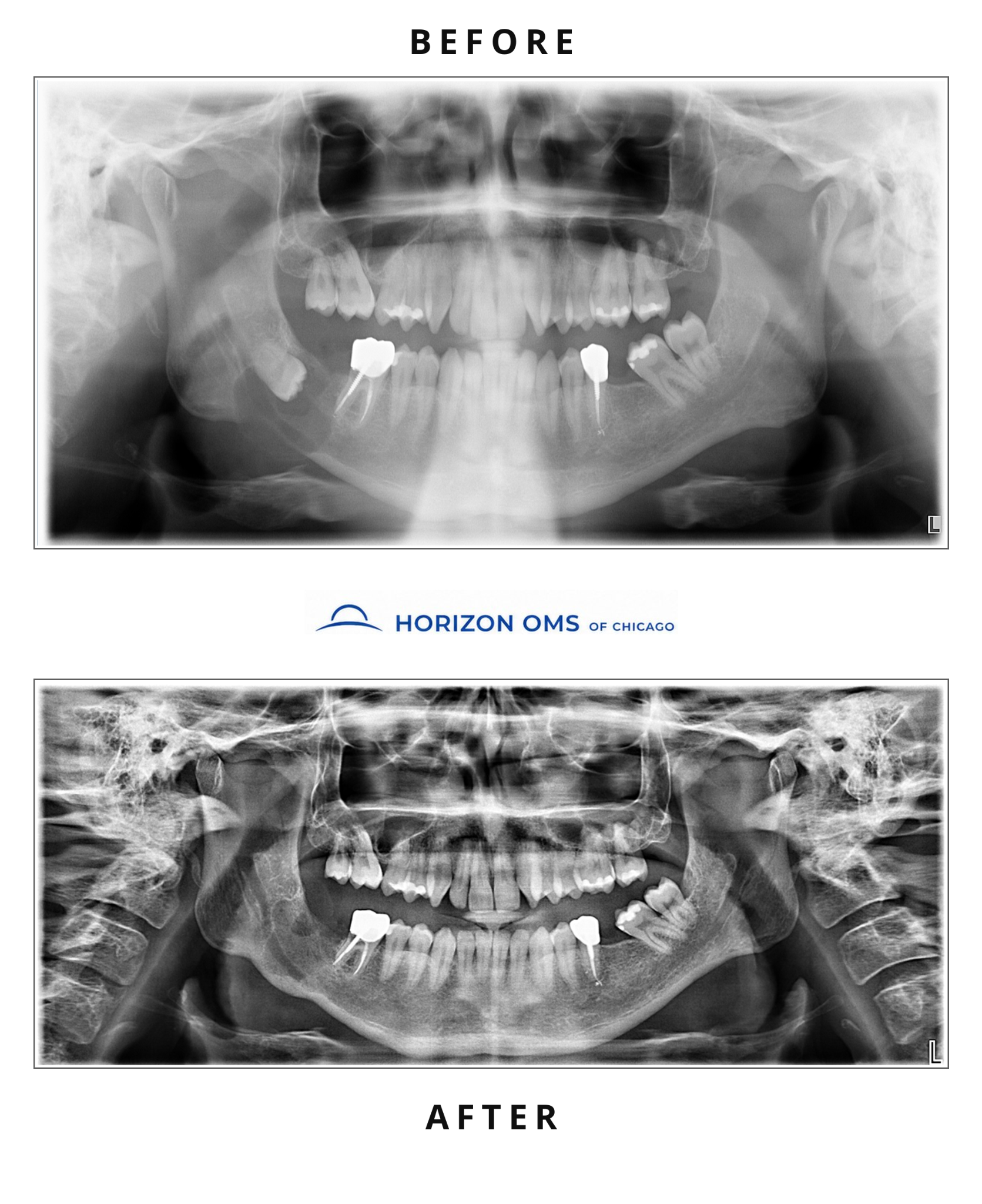 Before and after panoramic X-rays showing staged management of a large right mandibular cyst with decompression followed by enucleation and curettage — case treated by Dr. Ali Al-Qudsi at Horizon OMS of Chicago