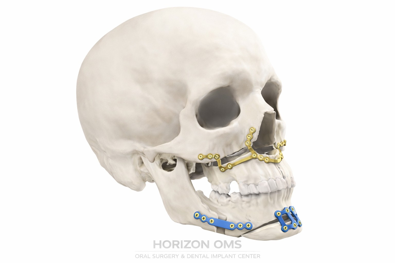 Corrective jaw surgery orthognathic surgery board-certified Illinois