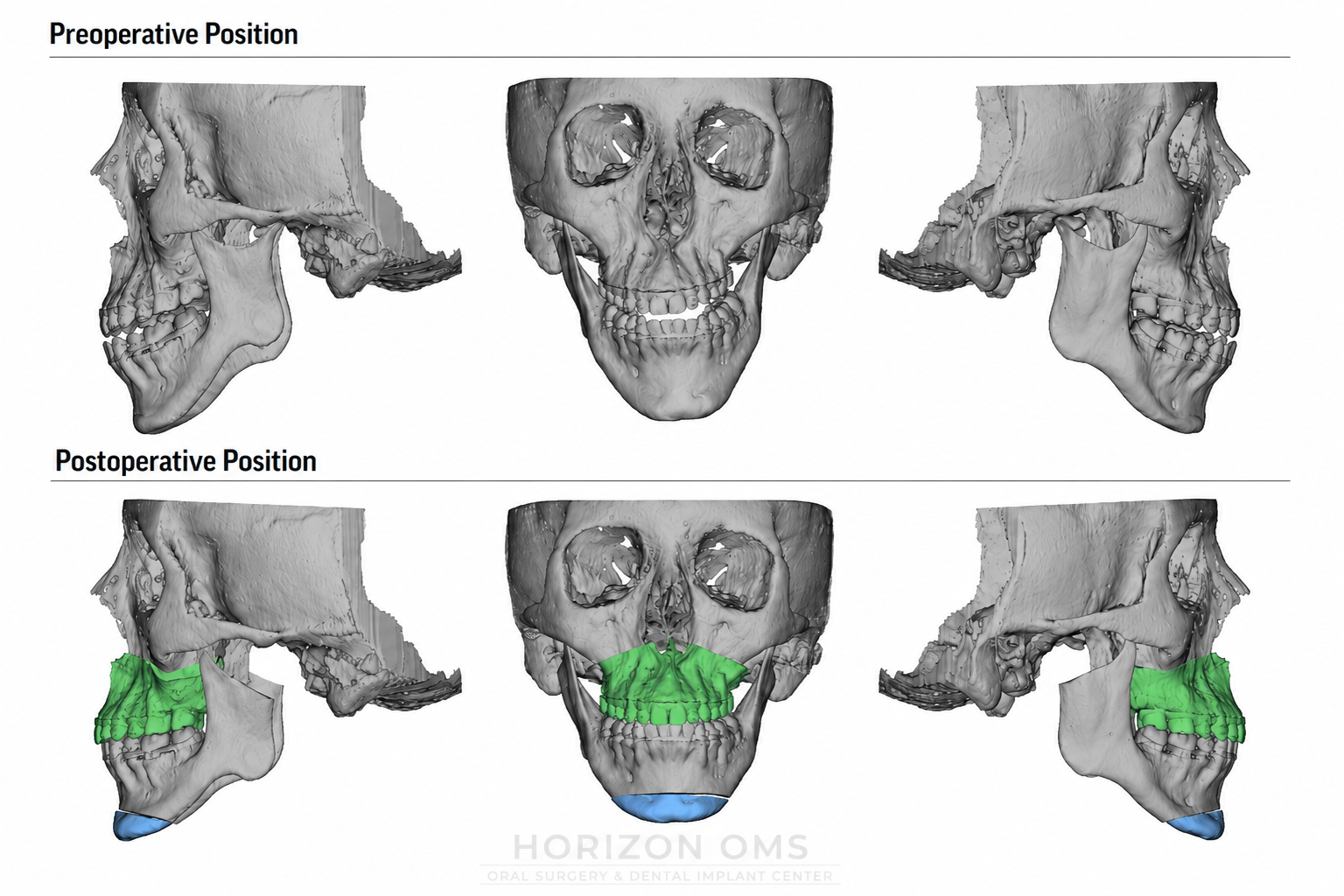 3D virtual surgical planning comparison showing preoperative and postoperative Le Fort I and genioplasty movements for corrective jaw surgery