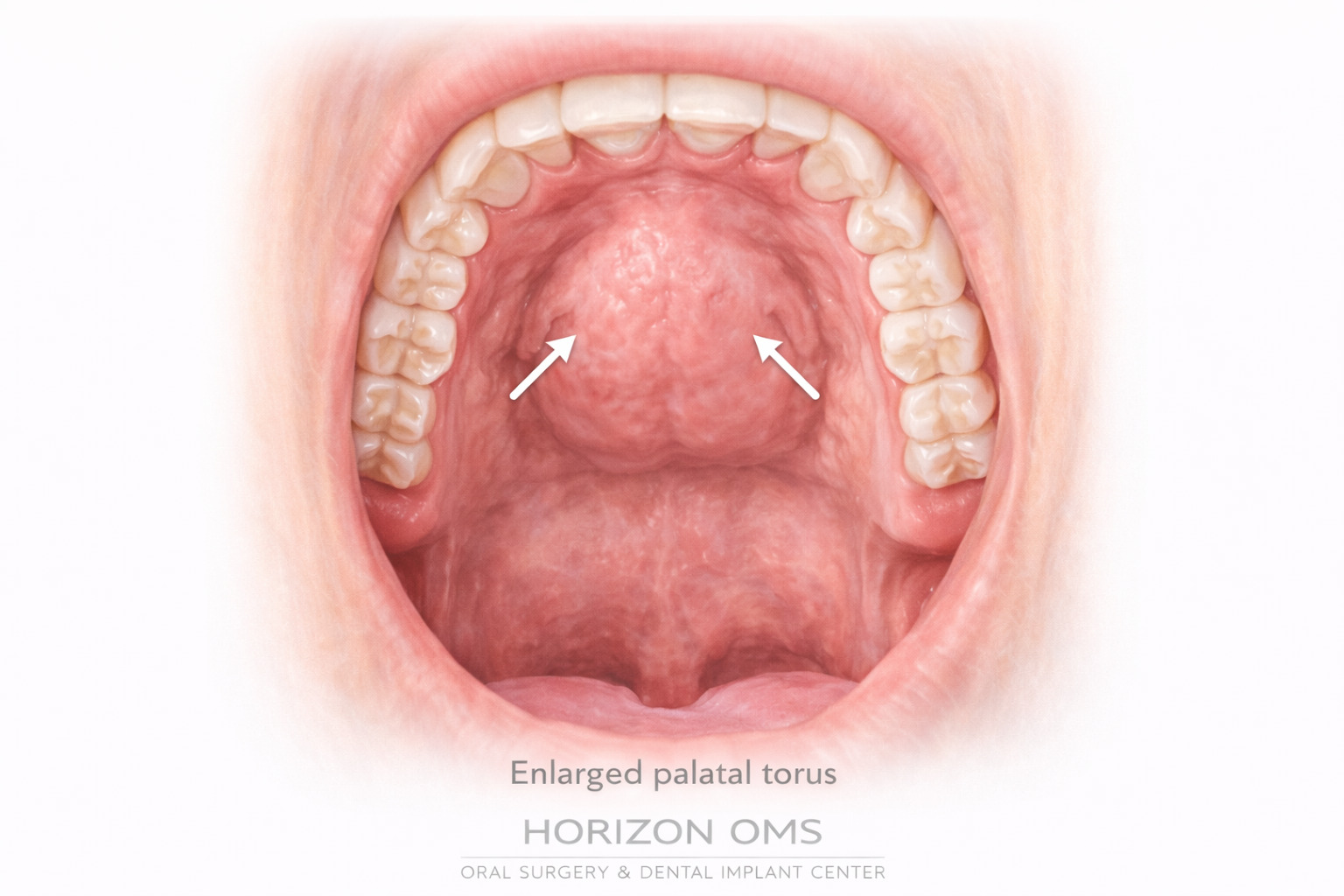 Palatal tori removal surgery for denture fit improvement Lombard IL