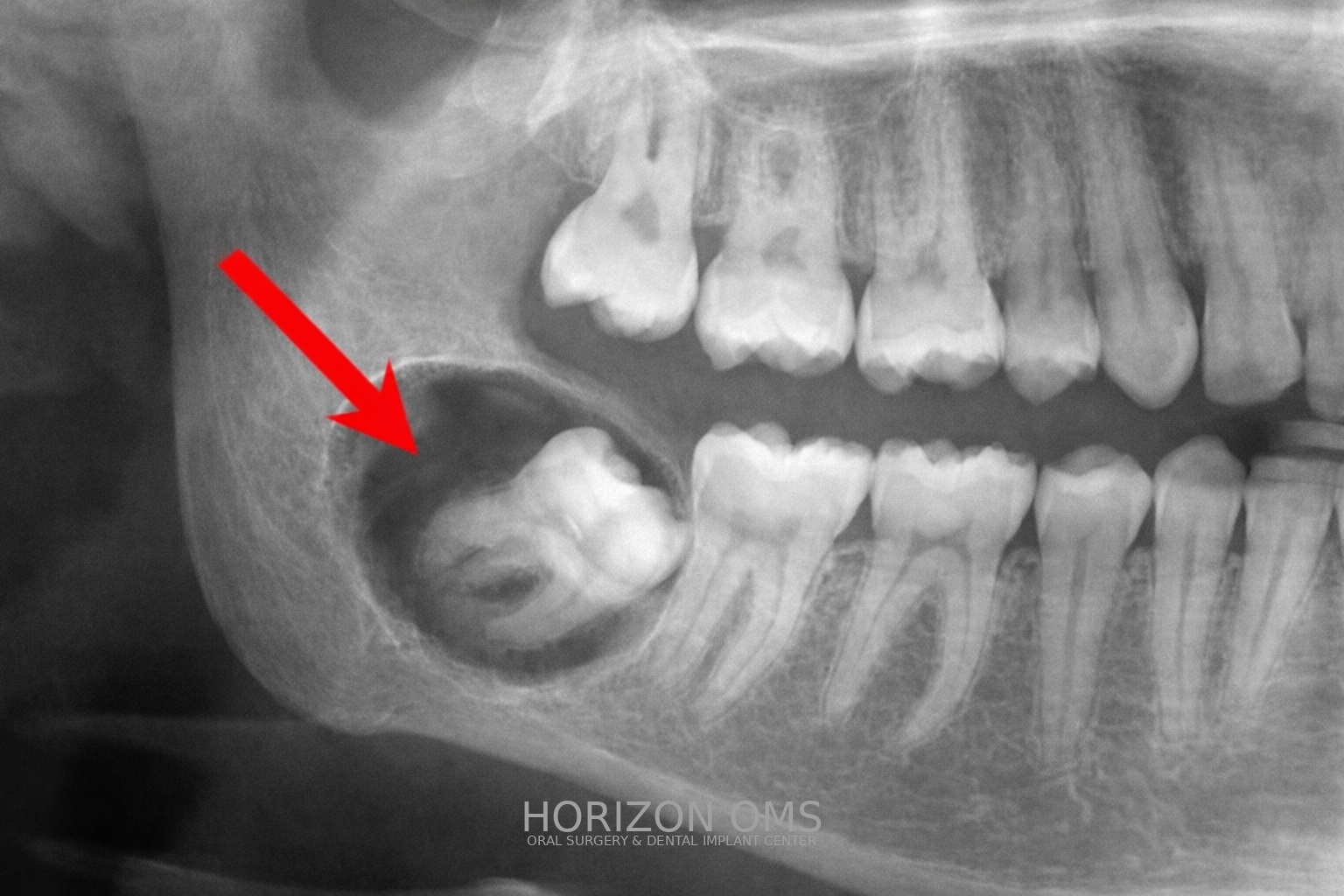Oral pathology biopsy procedure for lesion diagnosis Lombard IL oral surgeon