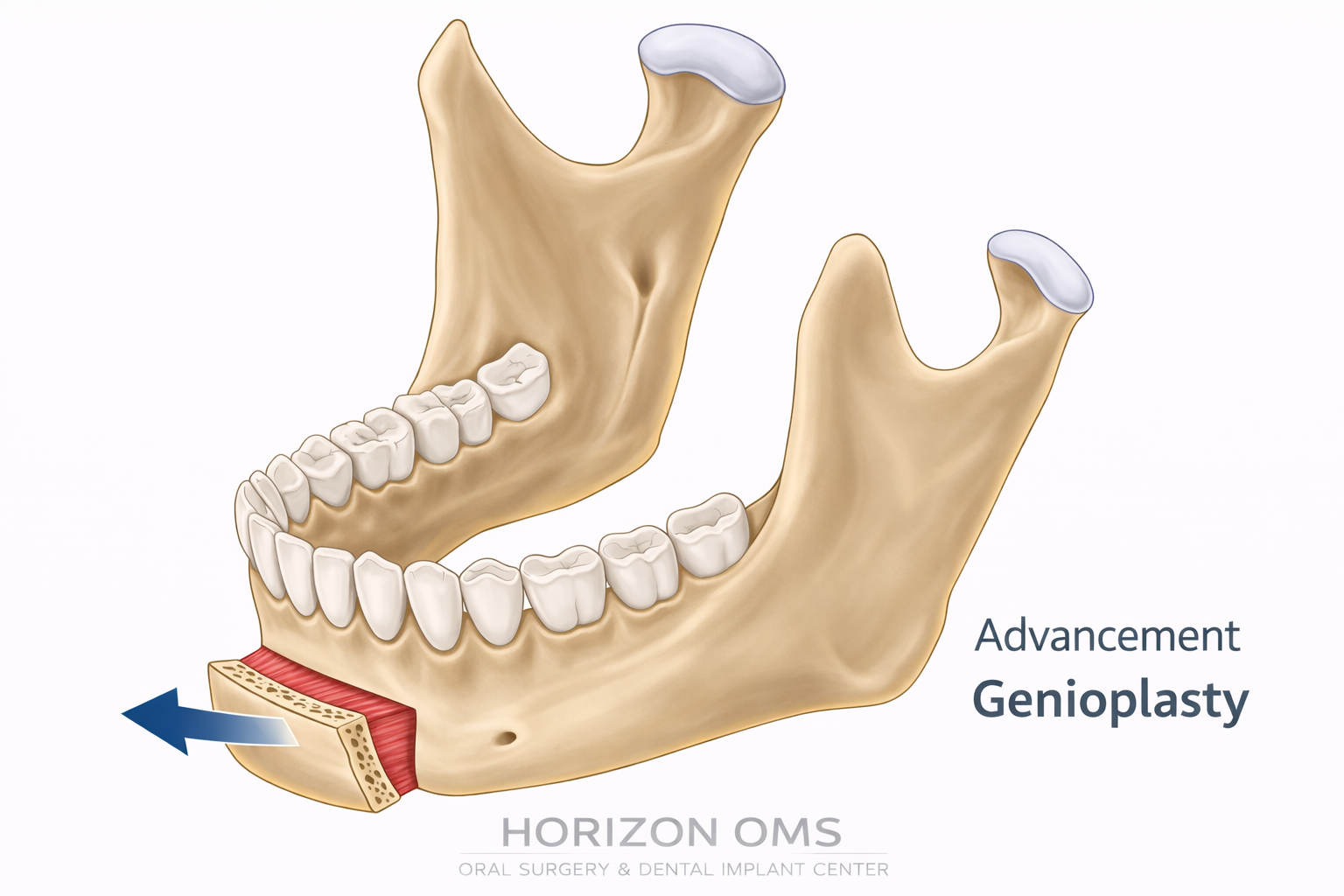 High genioplasty or genial tubercle advancement for sleep apnea showing forward movement of the chin segment and tongue muscle attachment