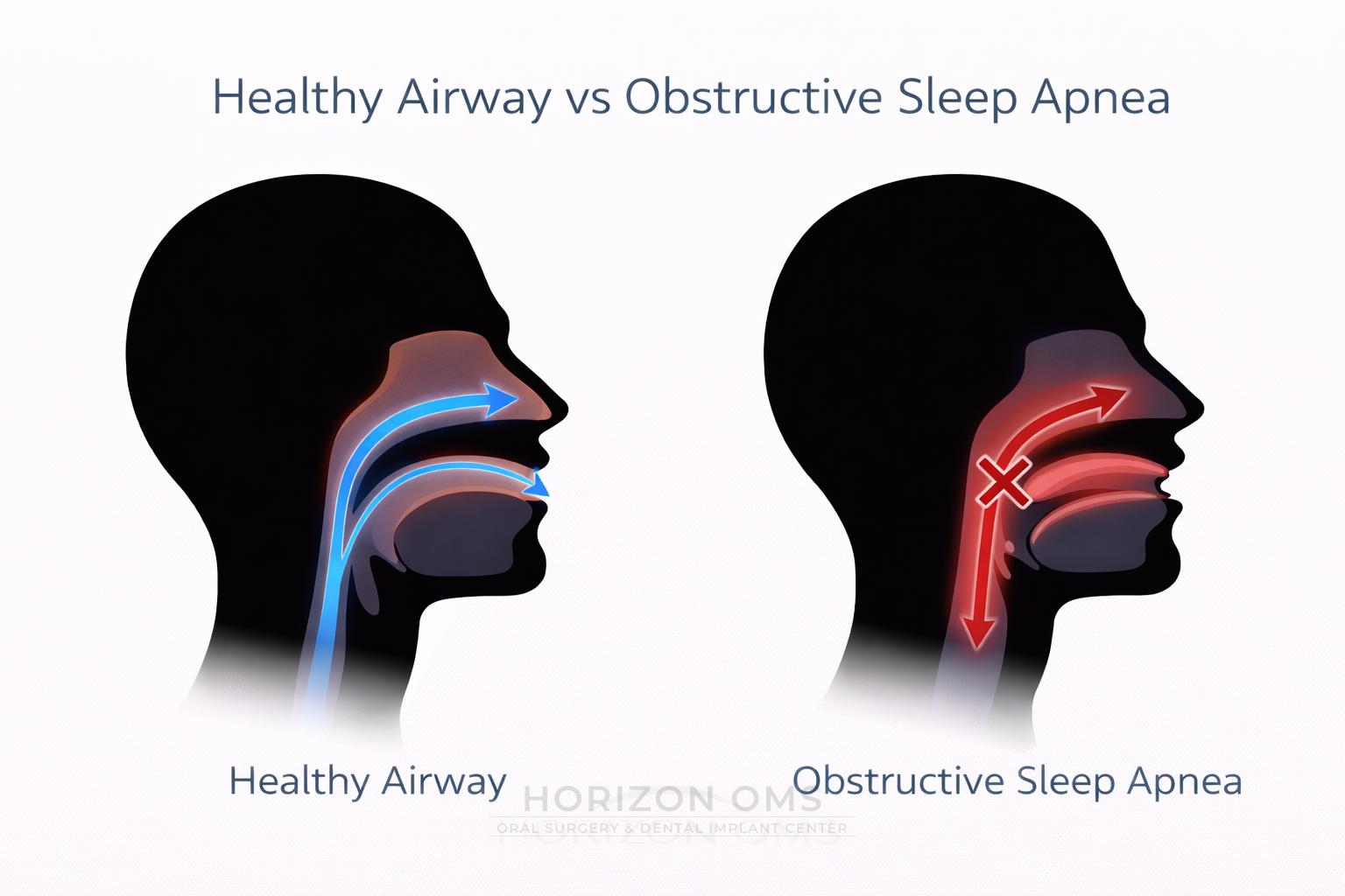 Healthy airway compared with obstructive sleep apnea showing tongue and soft palate collapse narrowing the airway
