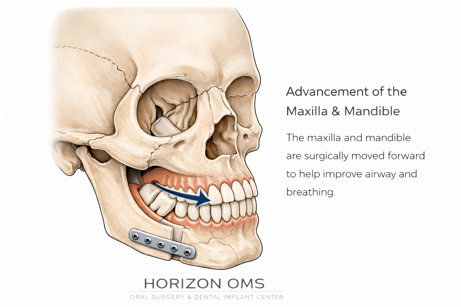 Maxillomandibular advancement surgery for obstructive sleep apnea showing forward repositioning of the upper and lower jaws to enlarge the airway
